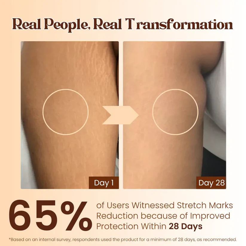 Pregnancy & Weight Stretch Mark Cream